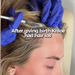 Postpartum hair loss treatment at Eustache Institute