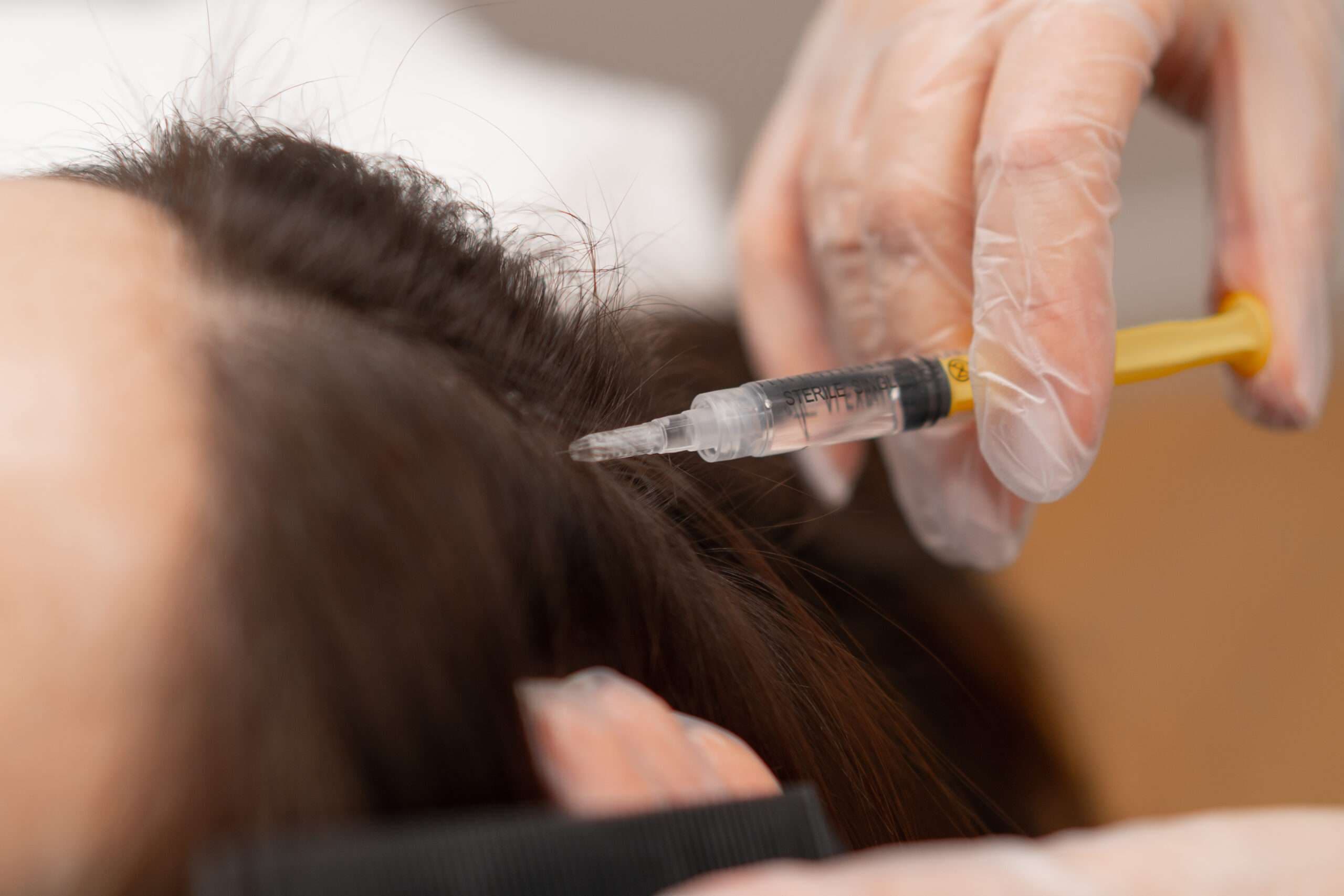 Specialist performing PRP scalp injections for hair restoration