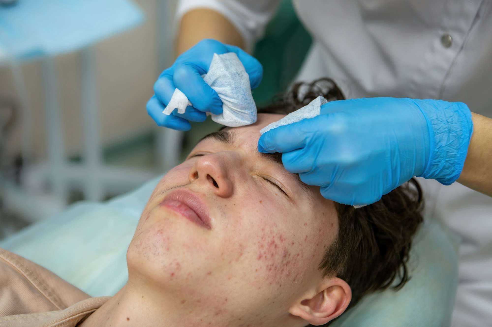 Facial peeling treatment to fight acne on patient's face