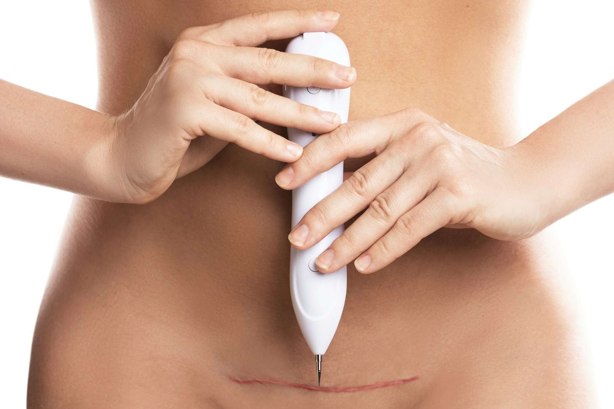 Plasma pen scar removal treatment on skin